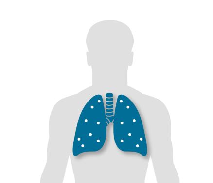 La pneumonie à pneumocoque